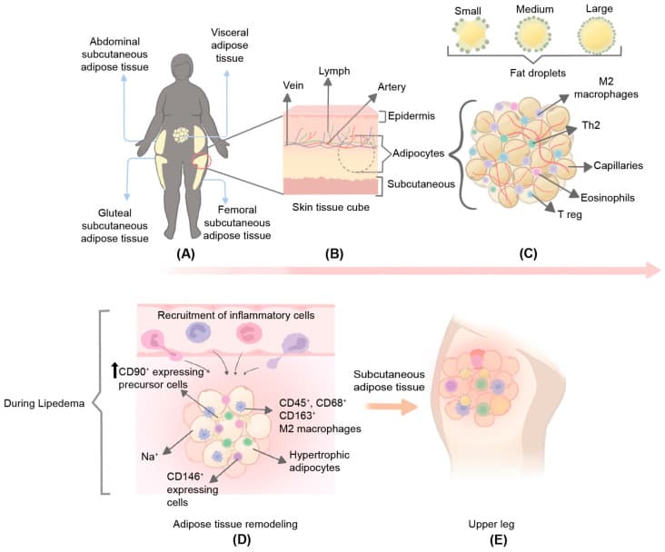 Figura científica: distribuição do tecido adiposo e microambiente do lipedema — (A) padrão de acúmulo glúteo/femoral poupando mãos e pés, (C–D) hipertrofia dos adipócitos, macrófagos M2 e microvasculatura no tecido acometido.